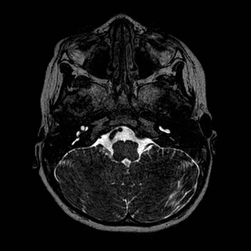 File:Cochlear nerve aplasia - unilateral (Radiopaedia 87910-104413 Axial T2 12).jpg