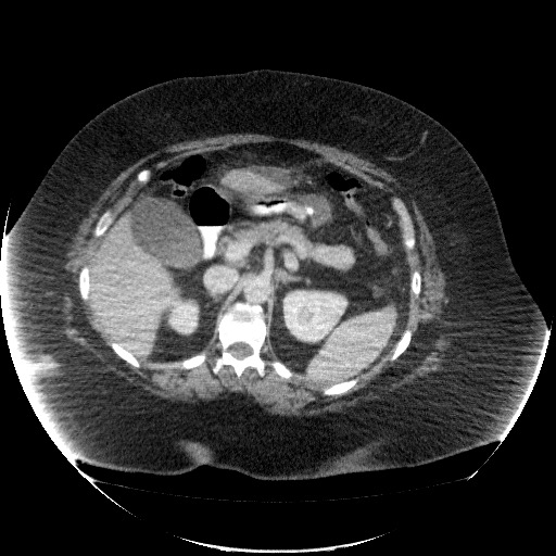 File:Collection due to leak after sleeve gastrectomy (Radiopaedia 55504-61972 A 29).jpg
