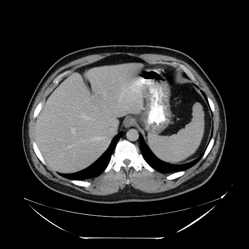 File:Colocolic intussusception due to lipoma (Radiopaedia 73712-84508 Axial 29).jpg