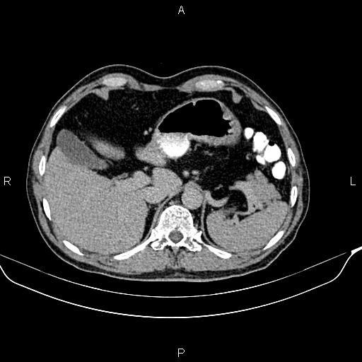 Colon adenocarcinoma (Radiopaedia 83266-97671 Axial C+ delayed 28).jpg