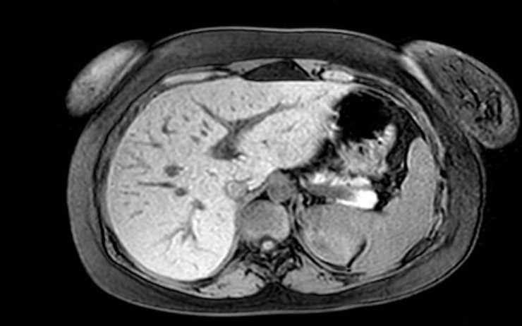 File:Colon adenocarcinoma with Krukenberg tumors, advanced pregnancy (Radiopaedia 67279-76645 A 66).jpg