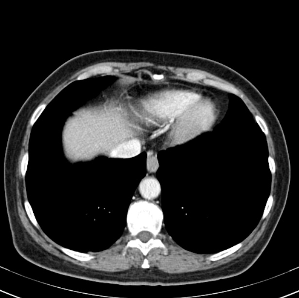 Colon carcinoma with hepatic metastases (Radiopaedia 29477-29961 A 10).jpg