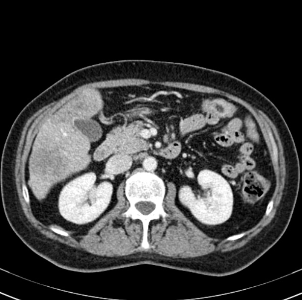 Colon carcinoma with hepatic metastases (Radiopaedia 29477-29961 A 44).jpg