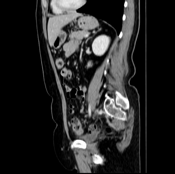 Colon carcinoma with hepatic metastases (Radiopaedia 29477-29961 C 36).jpg