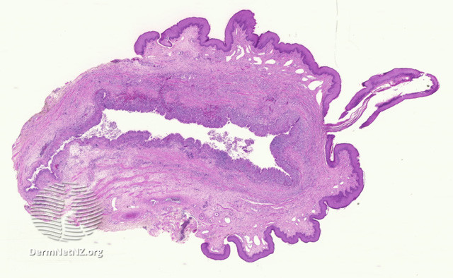 File:Figure 1 (DermNet NZ pathology-e-median-raphe-cyst-figure-1).jpg