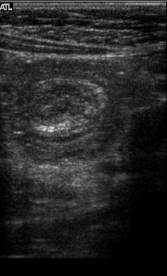 File:Intussusception (ultrasound) (Radiopaedia 3456).jpg