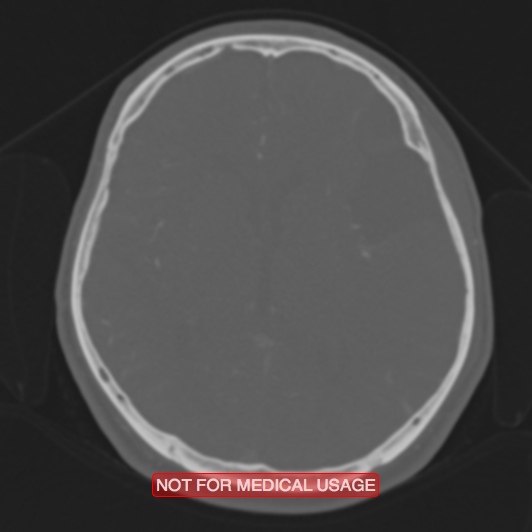 File:Nasopharyngeal carcinoma recurrence - skull base destruction (Radiopaedia 29107-29490 Axial bone window 51).jpg