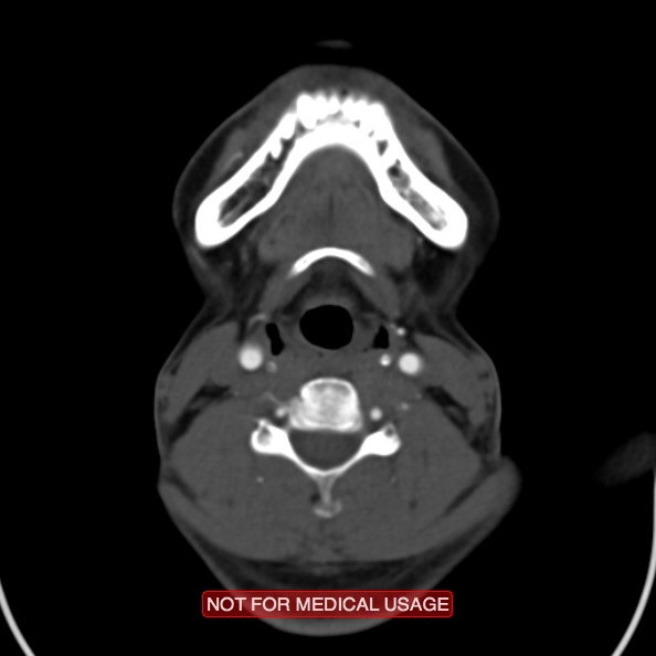 File:Nasopharyngeal carcinoma recurrence - skull base destruction (Radiopaedia 29107-29491 A 23).jpg