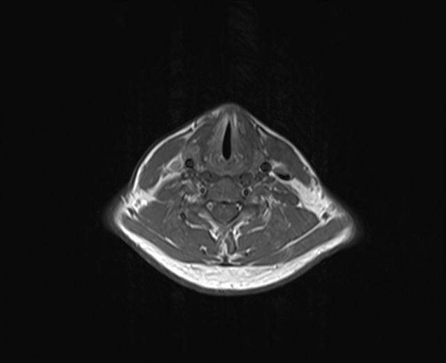 File:Nasopharyngeal carcinoma with perineural spread (Radiopaedia 55030-61380 Axial T1 9).jpg