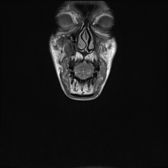 Nasopharyngeal carcinoma with skull base invasion (Radiopaedia 53415-59485 Coronal T1 40).jpg