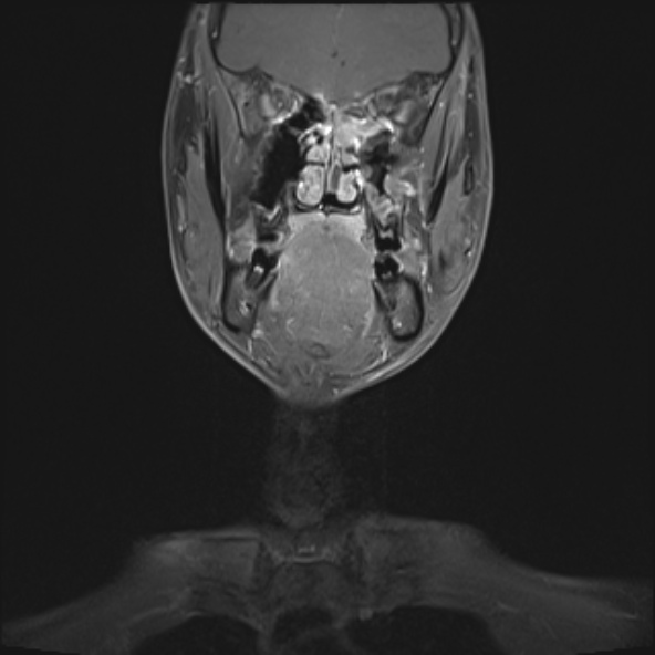 Nasopharyngeal carcinoma with skull base invasion (Radiopaedia 53415-59485 E 29).jpg
