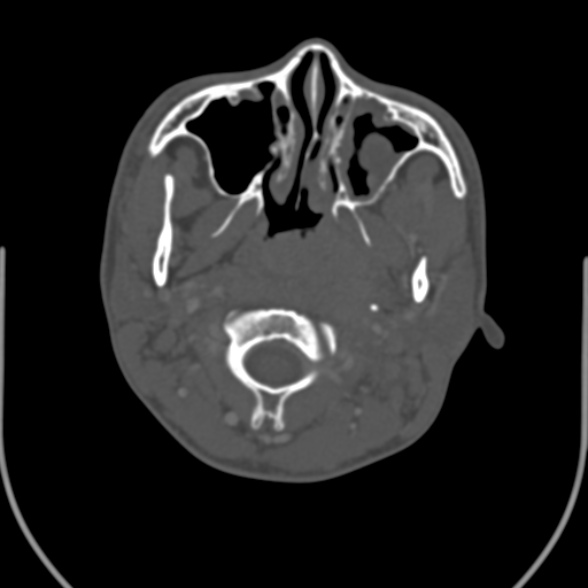 Nasopharyngeal carcinoma with skull base invasion (Radiopaedia 53415-59705 Axial bone window 57).jpg