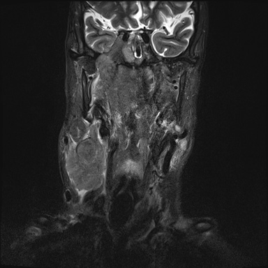 Nasopharyngeal carcinoma with skull base invasion (Radiopaedia 59258-66600 Coronal T2 fat sat 19).jpg