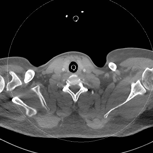 Neck CT angiogram (intraosseous vascular access) (Radiopaedia 55481-61945 B 132).jpg