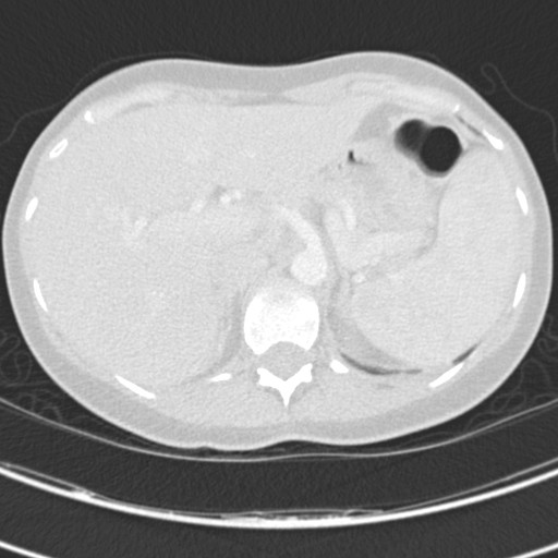 Necrobiotic pulmonary nodules - Crohn disease (Radiopaedia 20723-20631 Axial lung window 138).jpg