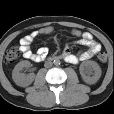 File:Necrotizing pancreatitis with acute necrotic collection (Radiopaedia 14470-14417 Axial non-contrast 25).jpg