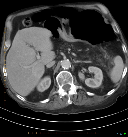 Necrotzing fasciitis due to a perforated adenocarcinoma of the splenic flexure (Radiopaedia 46930-51455 A 24).jpg