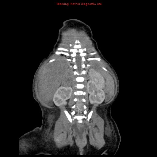File:Neonatal neuroblastoma (Radiopaedia 9564-10223 B 97).jpg