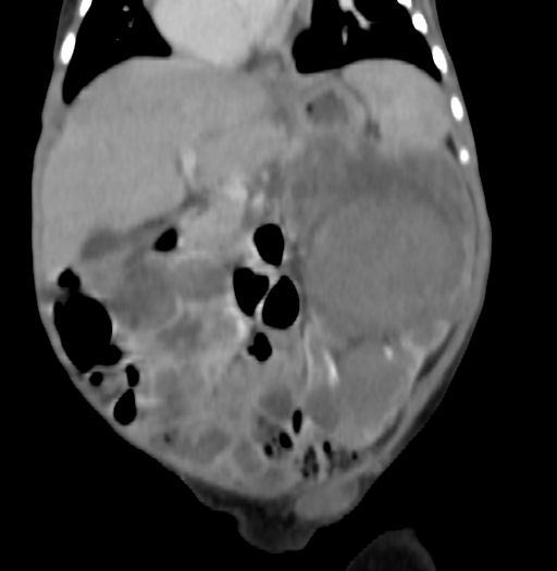 Nephroblastomatosis (Radiopaedia 71294-81607 B 170).jpg