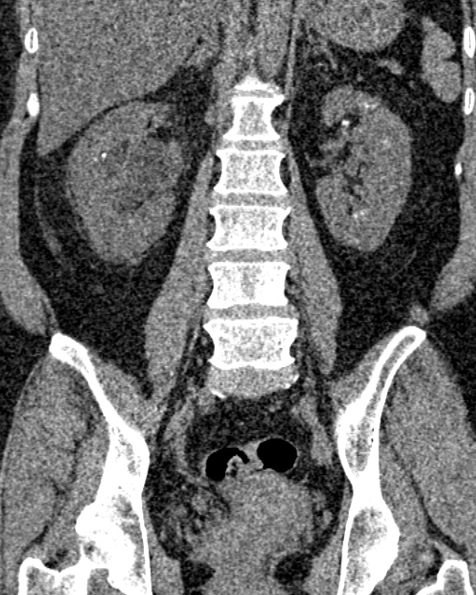 File:Nephrostomy for urosepsis (Radiopaedia 26180-26330 non-contrast 57).jpg