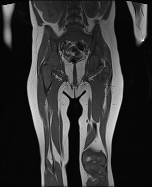 File:Neuroblastoma with bone metastases (Radiopaedia 67080-76414 Coronal T1 15).jpg