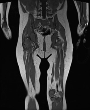 File:Neuroblastoma with bone metastases (Radiopaedia 67080-76414 Coronal T1 17).jpg