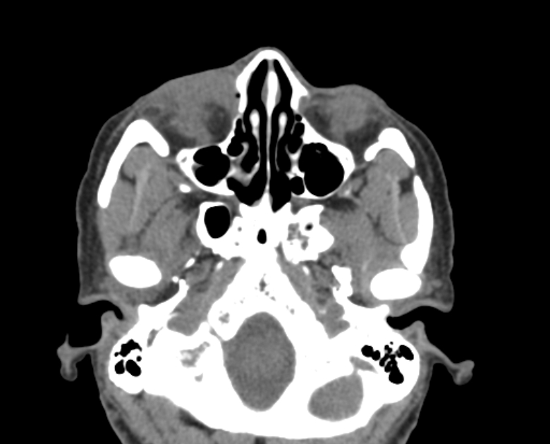 Neurofibromatosis type 1- orbital manifestations (Radiopaedia 49391-54511 Axial non-contrast 36).jpg