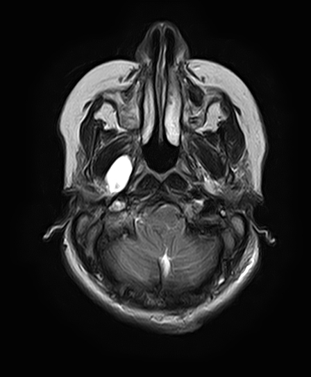 File:Neurofibromatosis type 2 (Radiopaedia 66211-75401 Axial T2 8).jpg