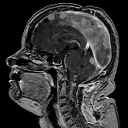 File:Neurofibromatosis type 2 (Radiopaedia 8713-9518 Sagittal T1 C+ 26).jpg