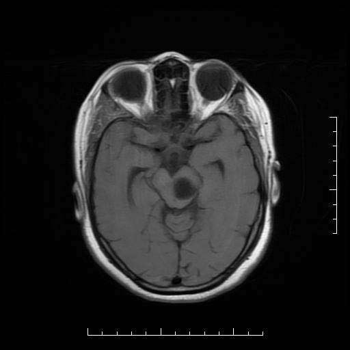 File:Neuroglial cyst of brainstem (Radiopaedia 29134-29526 Axial T1 8).jpg