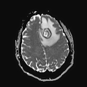 File:Neurotoxoplasmosis - concentric target sign (Radiopaedia 70644-80784 Axial ADC 16).jpg