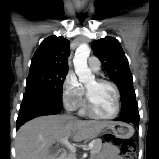 File:Non-small cell lung cancer with miliary metastases (Radiopaedia 23995-24193 B 7).jpg