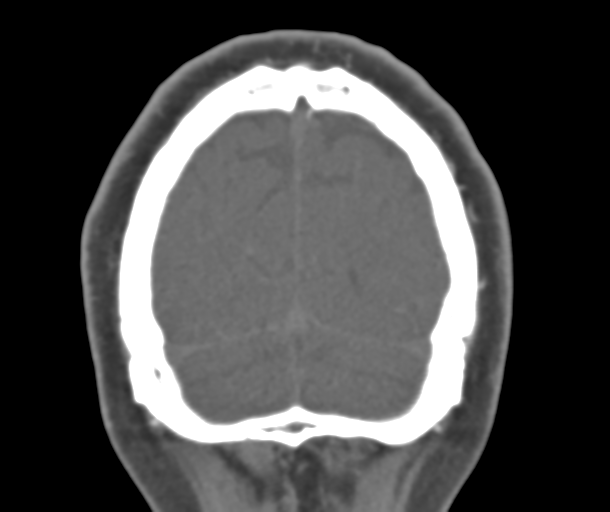 File:Normal CTA head (Radiopaedia 40801-43464 B 84).png