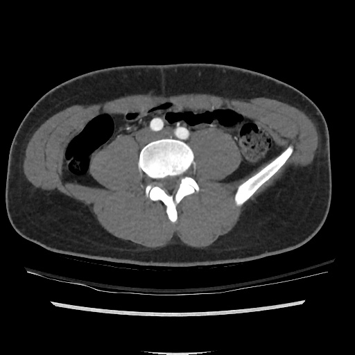 File:Normal CT angiogram of pelvis (Radiopaedia 45390-49430 A 17).jpg
