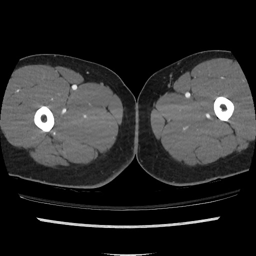 File:Normal CT angiogram of pelvis (Radiopaedia 45390-49430 A 76).jpg