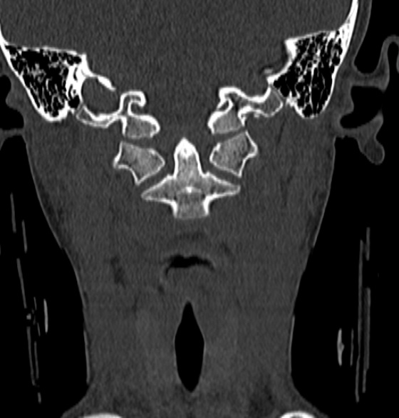 File:Normal CT cervical spine - 12-year-old (Radiopaedia 55352-61775 Coronal bone window 57).jpg