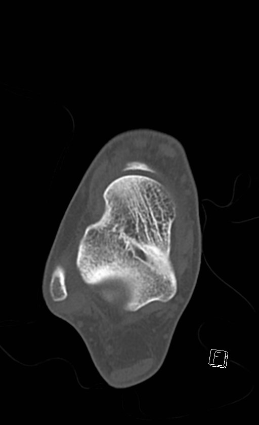 Normal CT of the ankle (Radiopaedia 47111-51658 Axial bone window 53).jpg