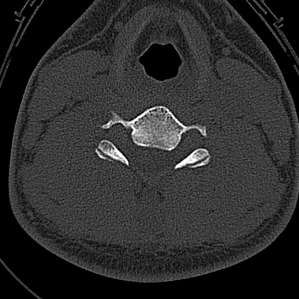 Normal CT of the cervical spine (Radiopaedia 53322-59305 Axial bone window 164).jpg