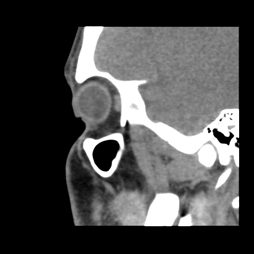 Normal CT paranasal sinuses (Radiopaedia 42286-45390 F 39).jpg