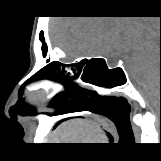 Normal CT paranasal sinuses (Radiopaedia 42286-45390 F 75).jpg