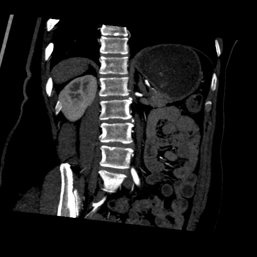 File:Normal CT renal artery angiogram (Radiopaedia 38727-40889 D 15).png