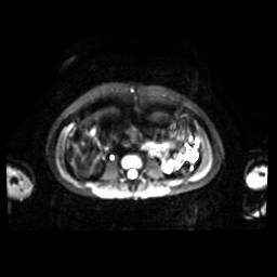 Normal MRI abdomen in pregnancy (Radiopaedia 88001-104541 Axial DWI 26).jpg