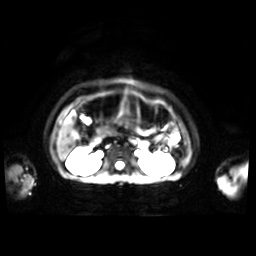 Normal MRI abdomen in pregnancy (Radiopaedia 88001-104541 Axial DWI 35).jpg