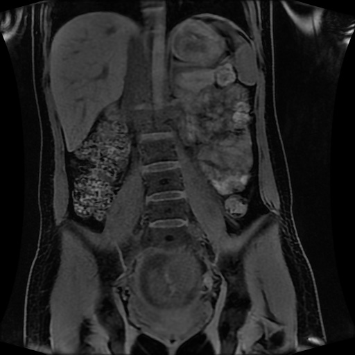 Normal MRI abdomen in pregnancy (Radiopaedia 88001-104541 M 83).jpg