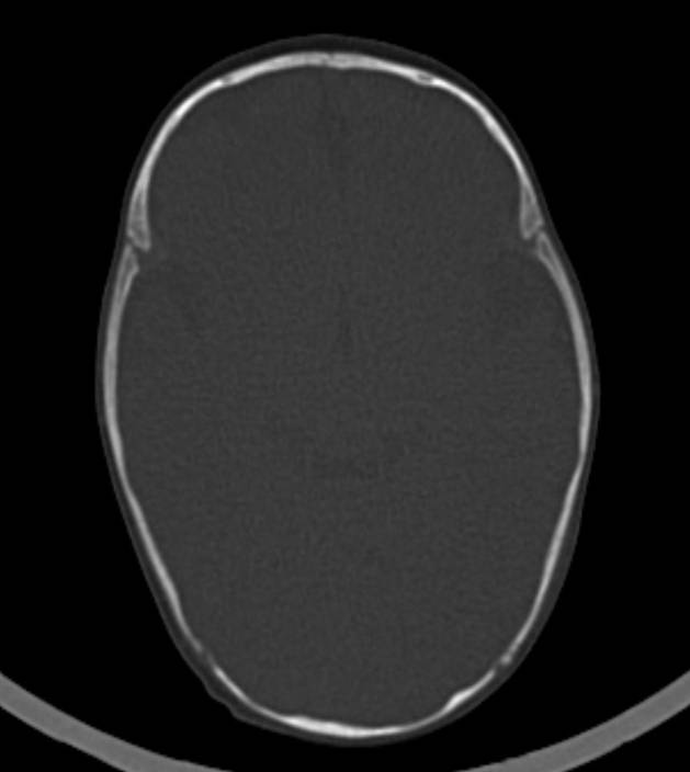 Normal brain CT - 2-month-old (Radiopaedia 53369-59350 Axial bone window 35).jpg