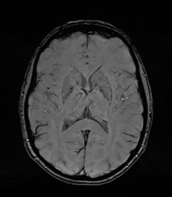 Normal brain MRI (TLE protocol) (Radiopaedia 40748-43405 Axial SWI 47).png