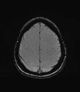 Normal brain MRI (TLE protocol) (Radiopaedia 40748-43405 Axial SWI 73).png