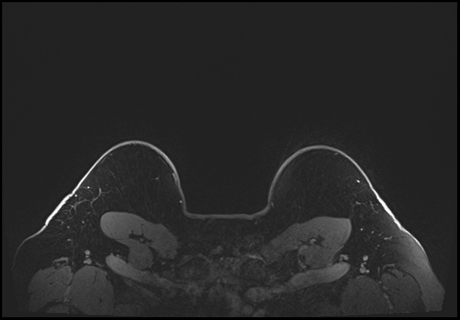 Normal breast MRI - dense breasts (Radiopaedia 80454-93850 C 213).jpg