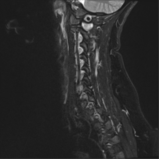 File:Normal cervical spine MRI (including Dixon) (Radiopaedia 42762-45925 Dixon- Water 3).png