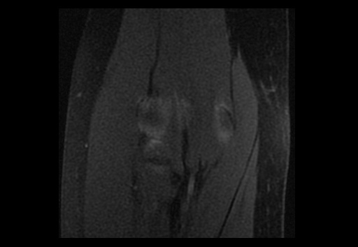 File:Normal elbow arthrograms (Radiopaedia 75550-86805 Coronal T1 fat sat 11).jpg